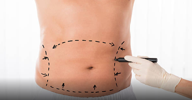 Tummy Tuck Procedure in Kuwait